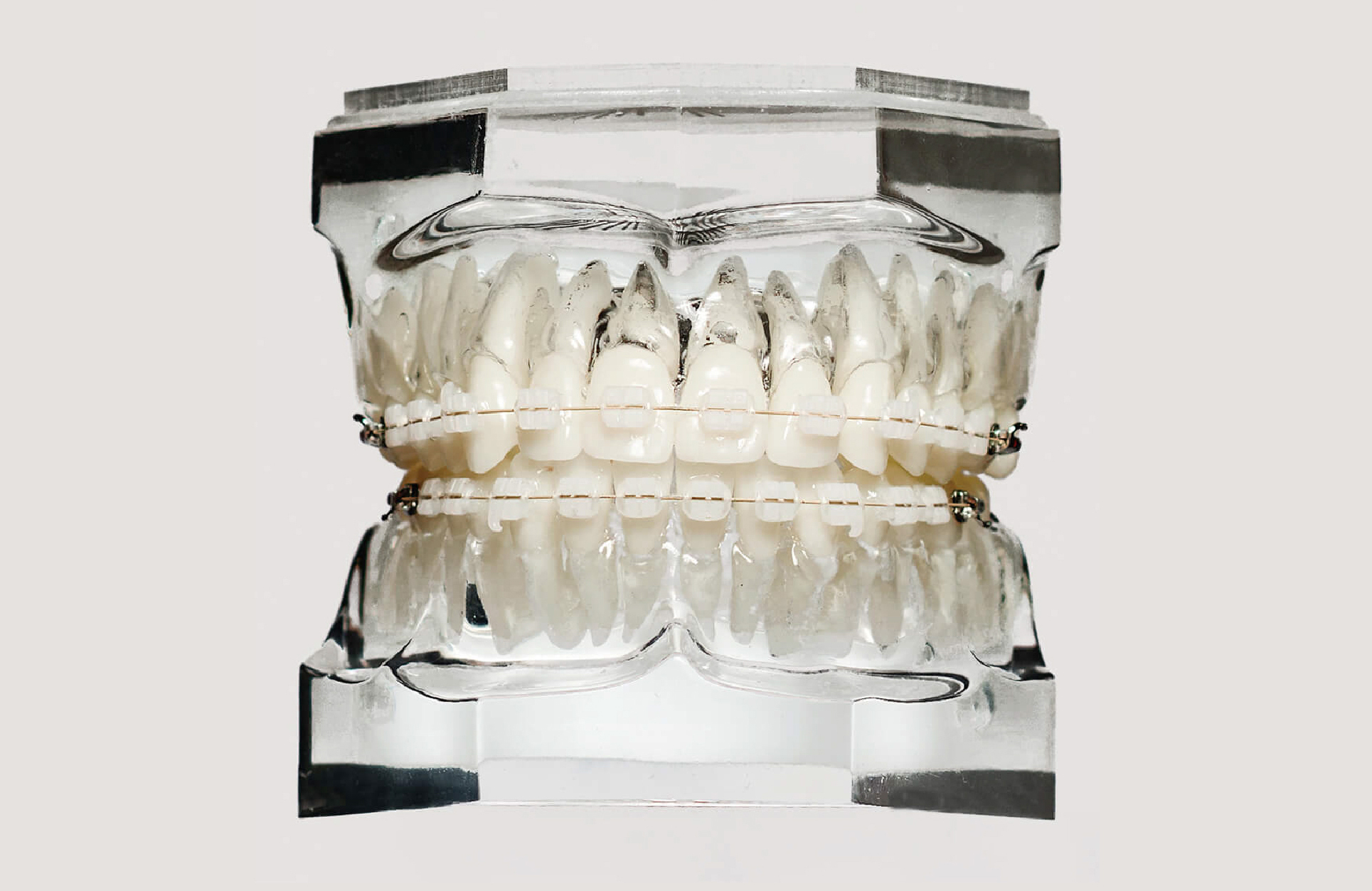LightForce custom 3D-printed ceramic braces displayed on a dental model – Riverview, FL 33578 – Orthodontic Gallery